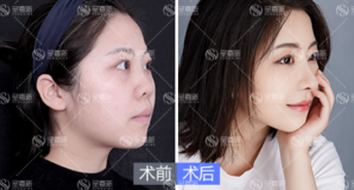 张立天：鼻综合与简单隆鼻的区别