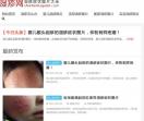 湿疹图片网